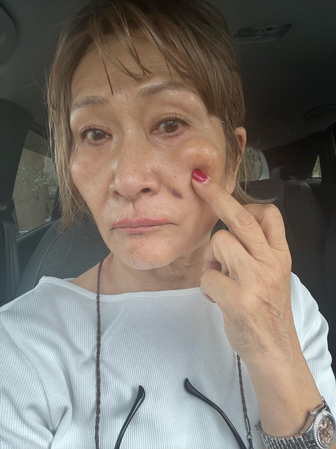 頬の気になる部分を指で示す三村由香